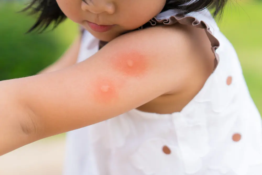 Red tick bites on a child’s arm, showing common tick bite symptoms.