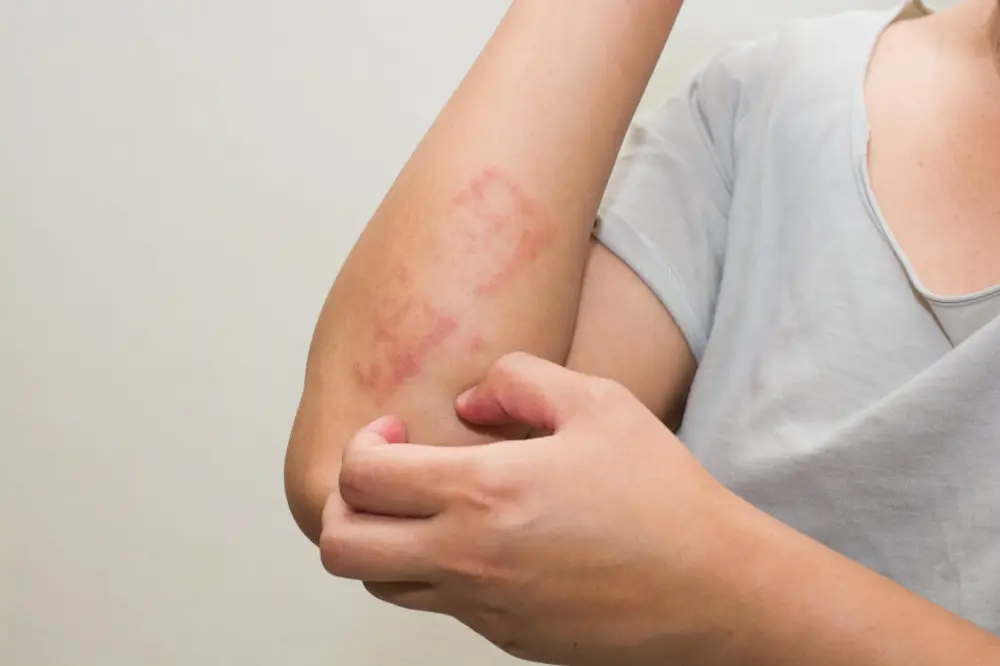 Person scratching a red skin rash on the arm, showing common allergy symptoms.
